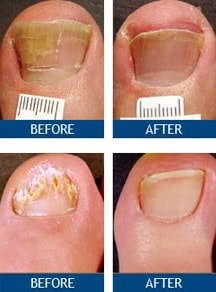 toenail fungus treatment pictures, Before and After toenail fungus laser treatment
