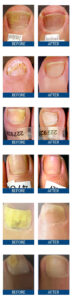 Before and after laser nail therapy for nail fungus