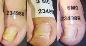 Toenail infected with nail fungus