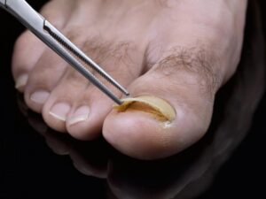 toenail fungus and pedicures