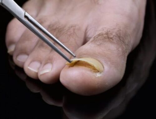 Treatment for Toenail Fungus in Riverside, CA