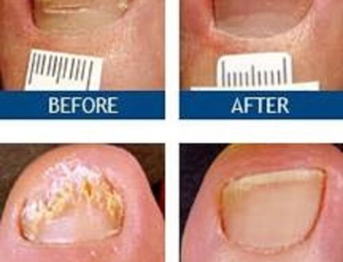 Best Toenail Fungus Treatment Option