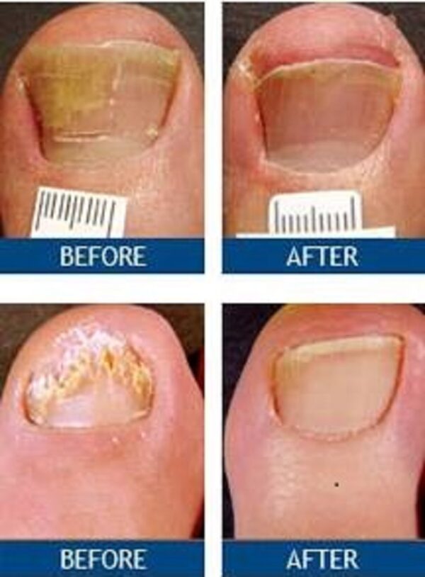 Nail Fungus and Nail bed Separation Toenail Fungus Treatment Center