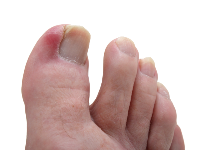 Toenail Fungus Relief in Los Angeles Toenail fungus Treatment Center