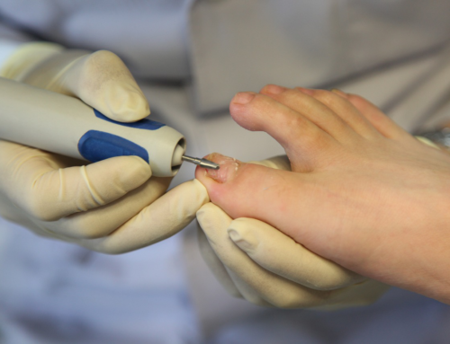 Toenail Fungus Laser Treatment in Walnut Creek