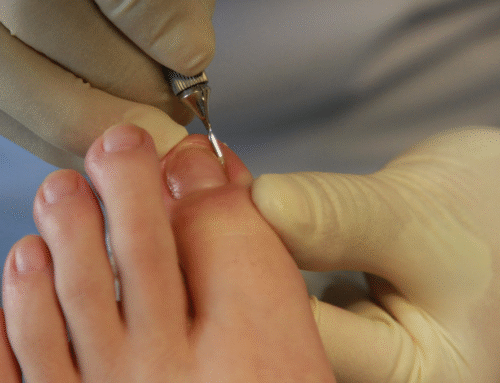 Toenail Fungus Treatment in Livermore, CA