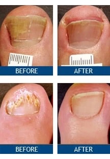 toenail fungus treatment results