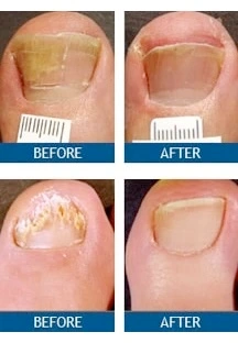 toenail fungus treatment results